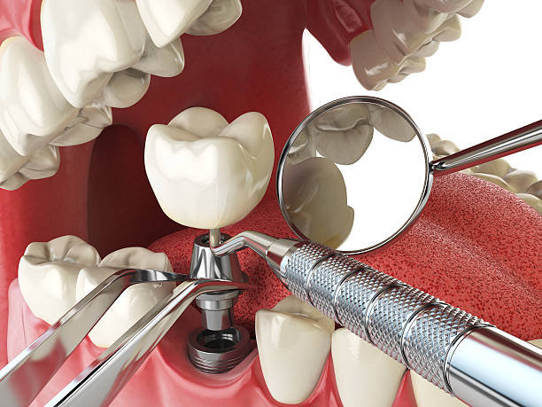 Best Chipped Tooth Repair Near Me  in Woodcrest, CA